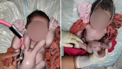 طفلة تولد بأربع أذرع وأربع أرجل تثير ضجة واسعة وتوصف بـ"معجزة الطبيعة"